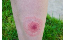 lyme_-_copie.jpg