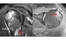 Diagnostic différentiel IRM de l'épaule oedème de la tête humérale dans un contexte post-traumatique