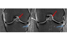Fracture de Segond