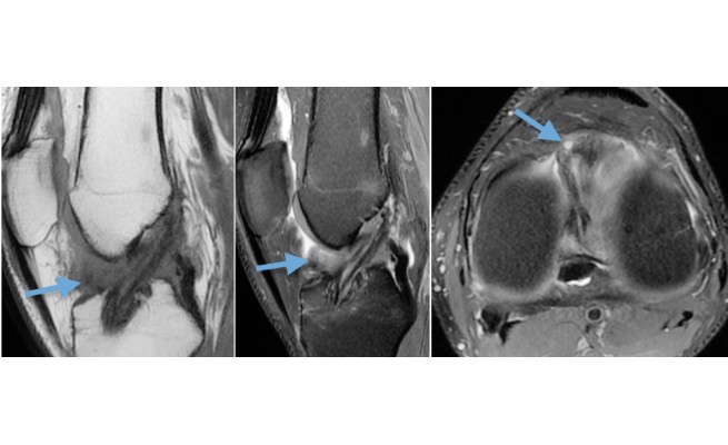 Mdk Arthrofibrose Ou cyclops Mdk Arthrofibrose Ou cyclops