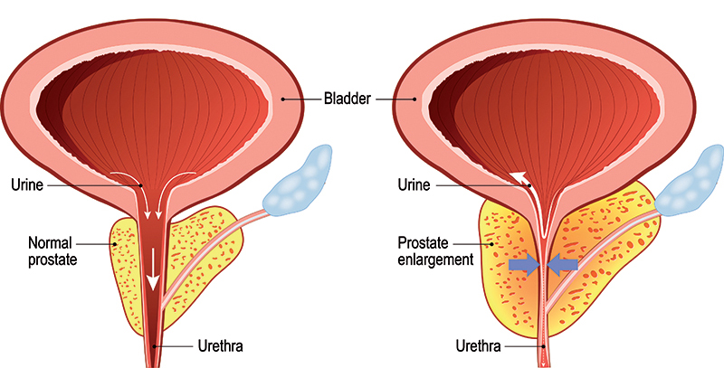 prostate hypertrophie)