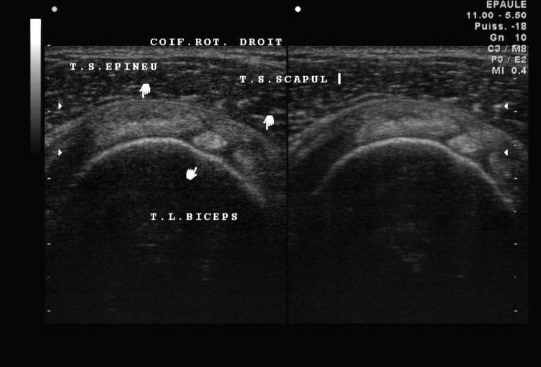 Formation kiné : tendinopathie épaule par électrothérapie 