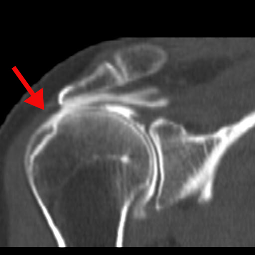 Formation kiné : tendinopathie épaule par électrothérapie 